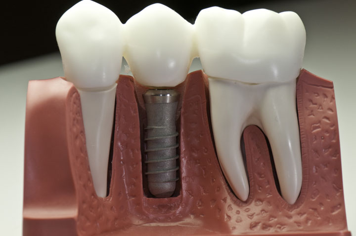 implants_4